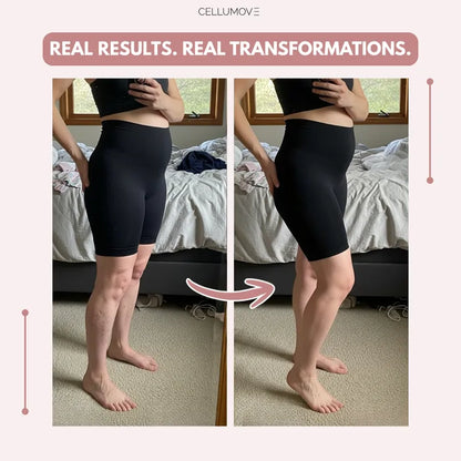 Oliron ShapeFlex™ 3D Legging – Post partum Edema