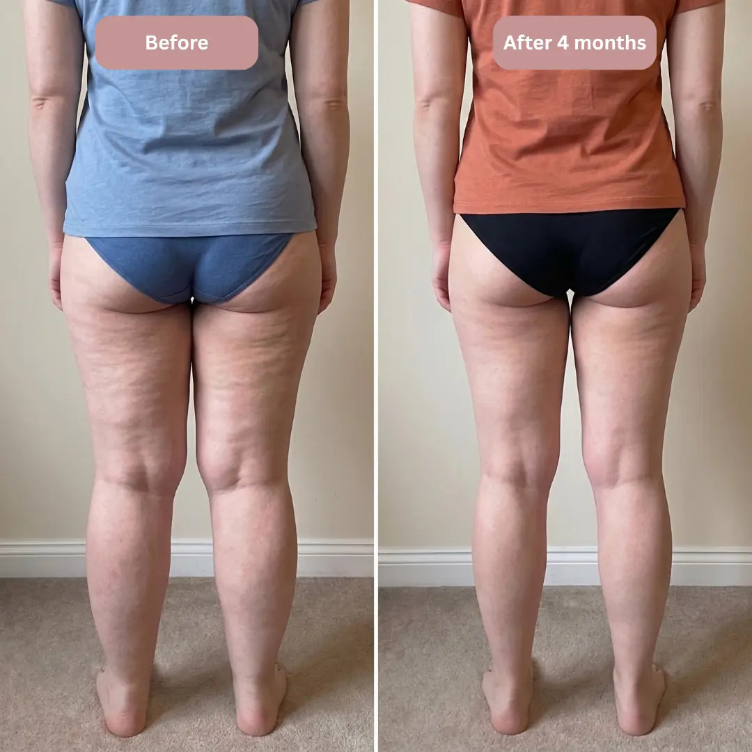 Oliron ShapeFlex™ 3D Legging – Say goodbye to lipoedema pain and swelling naturally