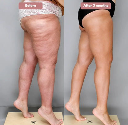 Oliron ShapeFlex™ 3D Legging – Say goodbye to lipoedema pain and swelling naturally
