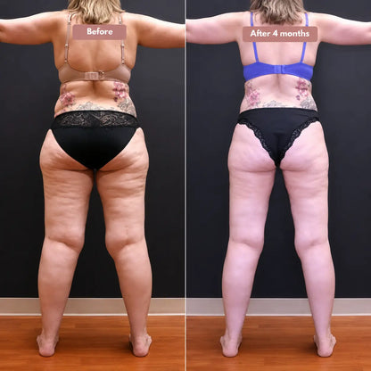 Oliron ShapeFlex™ 3D Legging – Say goodbye to lipoedema pain and swelling naturally
