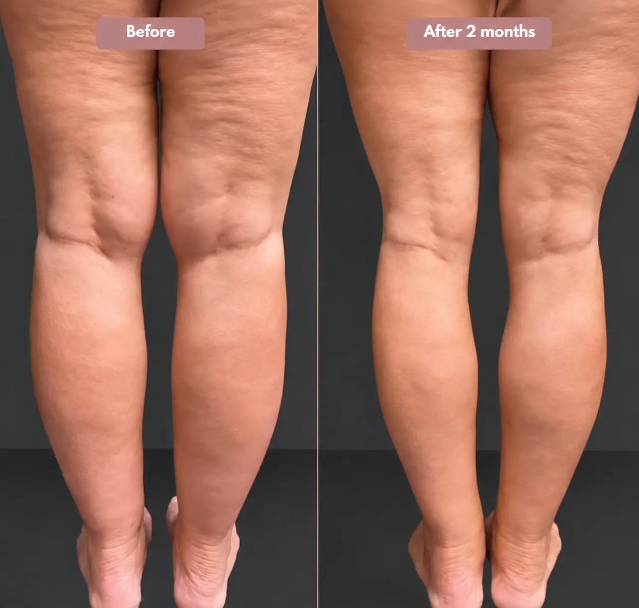 Oliron ShapeFlex™ 3D Legging – Say goodbye to lipoedema pain and swelling naturally